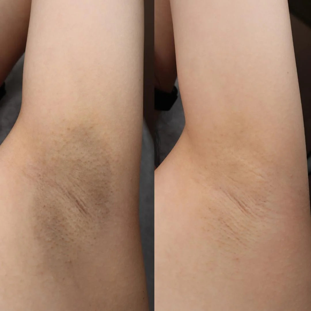 7% Glycolic Acid Toner – Clear Acne, Fade Dark Spots, Reveal Radiant Skin